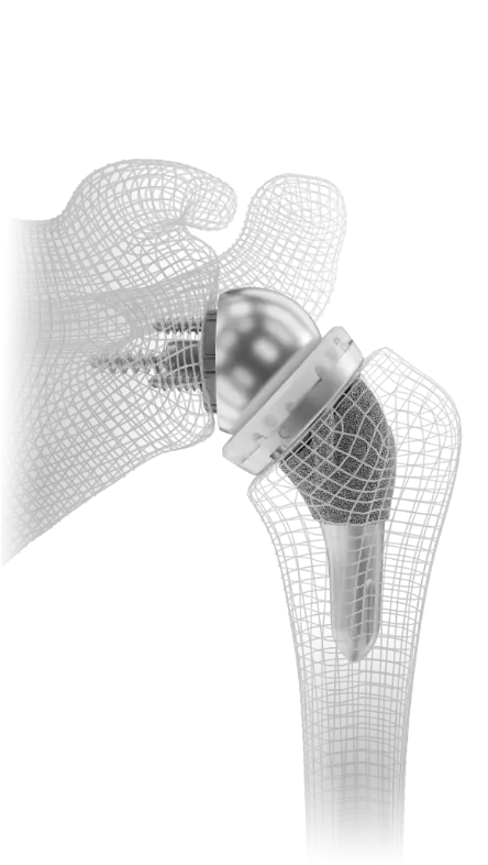 Shoulder Innovations InSet® Reverse Shoulder Replacement