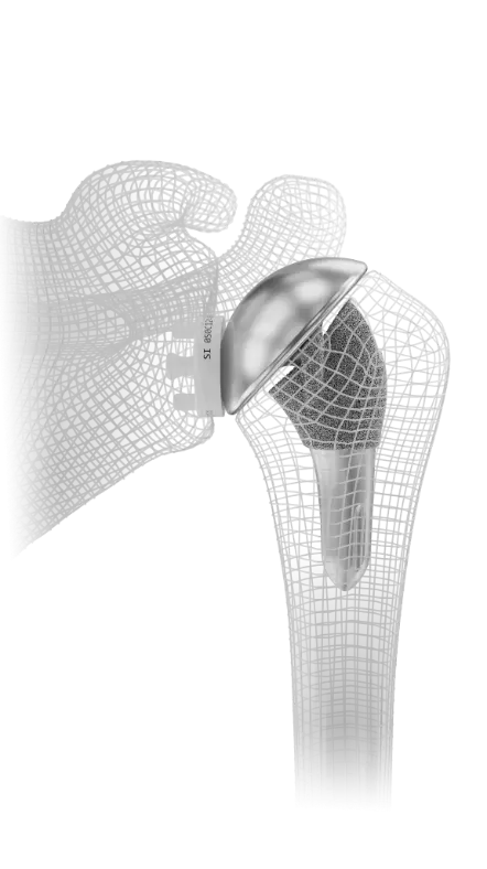 Shoulder Innovations InSet® Total Shoulder Replacement