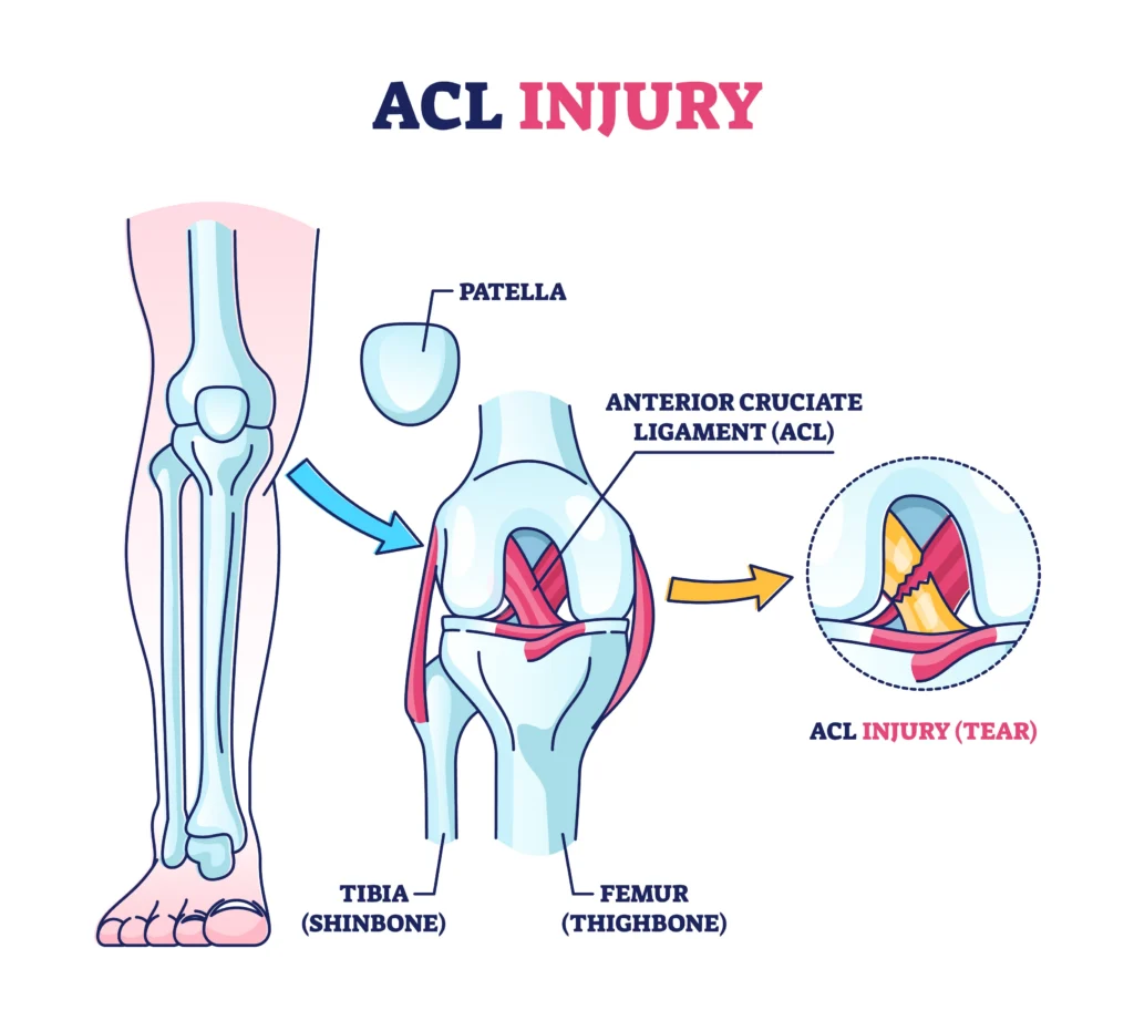 Diagram of ACL tear