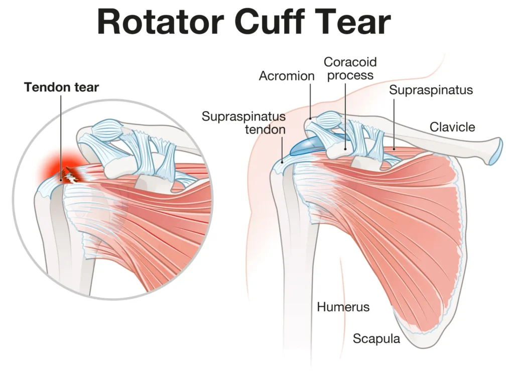 Diagram of rotator cuff tear