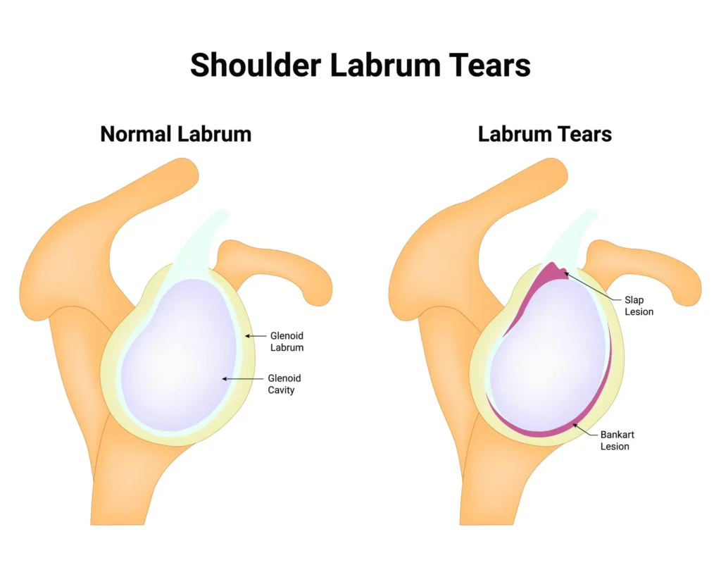 Diagram of shoulder labrum tear 