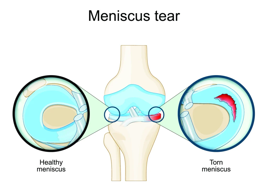 Meniscus tear